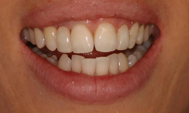 Gum lift & Bonding Before & After : Case Study - Lentini Dental