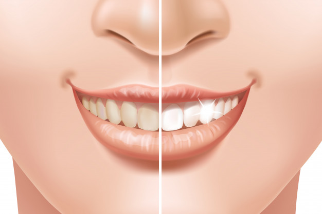 Great smile professional teeth whitening